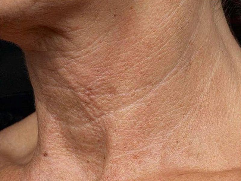 cum să scapi de deteriorarea pielii casting photo modele suisse anti aging